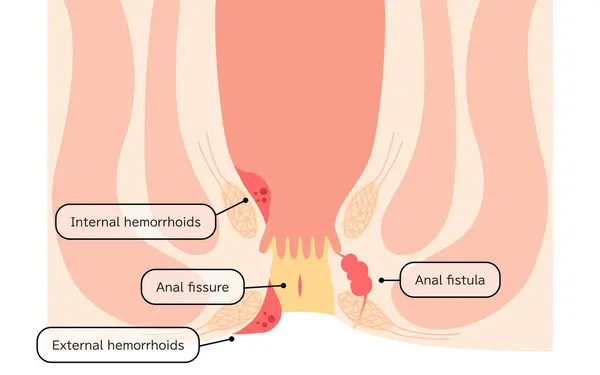 Diseases Anus Hemorrhoids Warts Cut Hemorrhoids Anorectal Hemorrhoids Illustration Cross —  Vetores de Stock