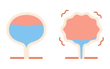 Medical illustration of overactive bladder, normal bladder vs, Vector Illustration clipart
