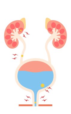 İdrar yolu taşları, böbrek taşları idrar kesesi taşları, idrar taşları, idrar yolu taşları, Vektör İllüstrasyonu.