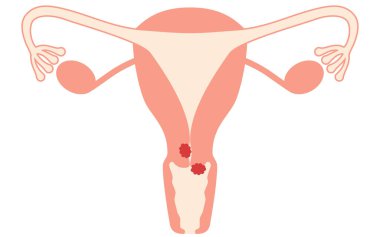 Rahim kanseri diyagramsal çizimi, rahim ve yumurtalıkların anatomisi, Vektör İllüstrasyonu