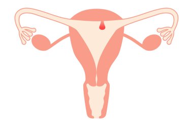 Endometriyal poliplerin diyagramatik çizimi, rahim ve yumurtalıkların anatomisi, Vektör İllüstrasyonu