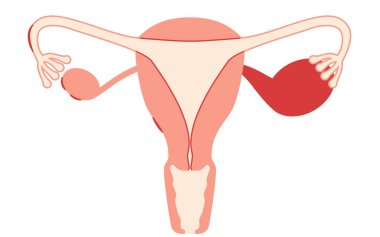 Endometriyozisin diyagramatik çizimi, rahim ve yumurtalıkların anatomisi, Vektör İllüstrasyonu