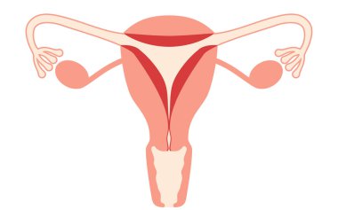 Endometriyal hiperplazinin diyagramatik çizimi, rahim ve yumurtalıkların anatomisi, Vektör İllüstrasyonu