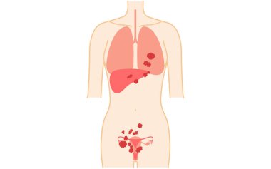 Dördüncü evre yumurtalık kanserinin diyagramatik çizimi, rahim ve yumurtalıkların anatomisi, rahim ve yumurtalıkların anatomisi - Çevirisi: Kanser karaciğere, akciğerlere, vb..