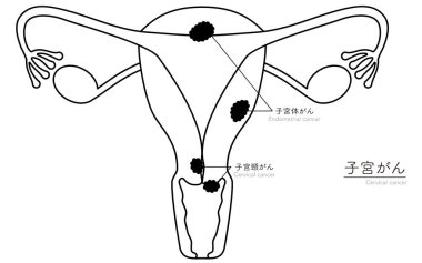 Rahim kanseri diyagramsal çizimi, rahim ve yumurtalıkların anatomisi, Vektör İllüstrasyonu