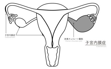 Endometriyozisin diyagramatik çizimi, rahim ve yumurtalıkların anatomisi, Vektör İllüstrasyonu