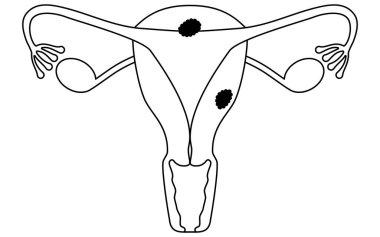 Illustrative illustrations of Endometrial cancer, anatomy of the uterus and ovaries, Vector Illustration clipart
