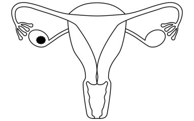 Birinci evre yumurtalık kanserinin diyagramatik çizimi, rahim ve yumurtalıkların anatomisi, rahim ve yumurtalıkların anatomisi - Çevirisi: Kanser sadece yumurtalıklarla ya da fallop tüpleriyle sınırlı.