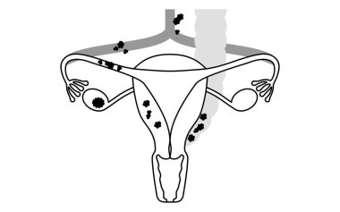 Üçüncü evre yumurtalık kanseri, rahim ve yumurtalıkların anatomisi, rahim ve yumurtalıkların diyagramsal çizimi - Çevirisi: Kanser lenf düğümlerine ya da pelvis boşluğundan peritonuma, büyük mezanteriye ya da küçük I 'ye yayılmış