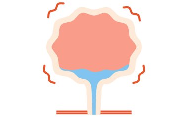 Mesanenin aşırı aktif olduğunun tıbbi bir göstergesi. İdrar kesesinde idrar olmamasına rağmen mesanenin kasıldığı bir durum.