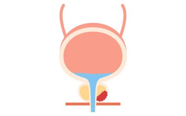 Prostatın Tıbbi İllüstrasyonu, Üçüncü Aşama Prostat Kanseri, Vektör İllüzyonu