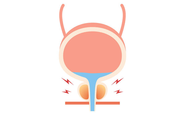 Medical Illustration of Prostate, Prostatitis, Vector Illustration