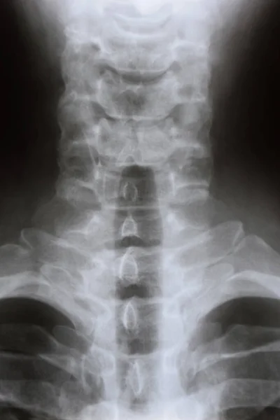 Close-up lateral X-ray of the neck and cervical spine of a person