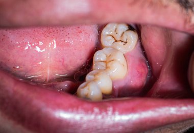 Kötü ağız ve diş sağlığı, çürükler, diş eti hastalıkları ve şişmiş diş etleri diş ağrısına yol açabilir. Dişler siyaha boyanmış, plaktan ve sarıdan kirlenmiş..