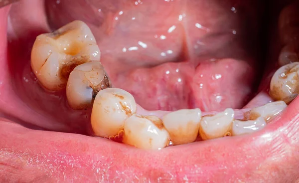 Decadência Dentária Dentes Partidos Saúde Oral Saúde Dentária Deficiente Problemas Imagens De Bancos De Imagens Sem Royalties