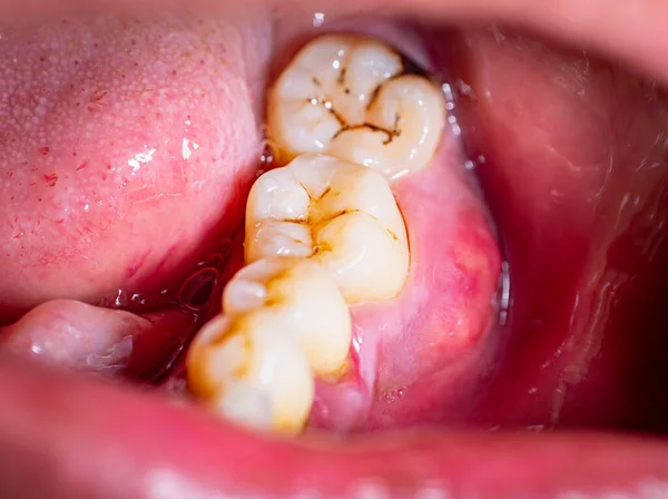 Mala Salud Bucal Dental Las Caries Enfermedad Las Encías Inflamación Fotos de stock