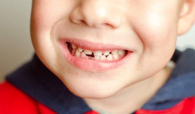 Ön dişi olmayan bir çocuğun gülümsemesi. 5 yaşında bir çocuk ön kesici dişini kaybetmiş.