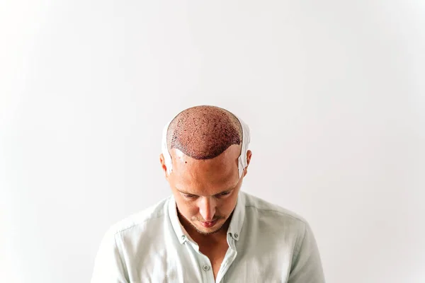 Nach Der Haartransplantation Chirurgische Technik Die Haarfollikel Bewegt Junger Mann lizenzfreie Stockbilder