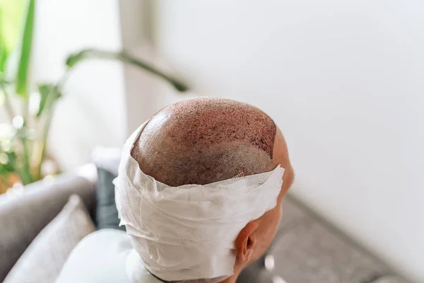 Nach Der Haartransplantation Chirurgische Technik Die Haarfollikel Bewegt Junger Mann Stockbild