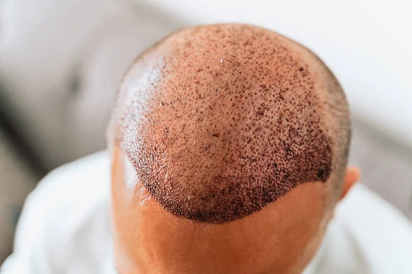 Hair Transplantation Surgical Technique Moves Hair Follicles Young Bald Man — Stock Photo, Image