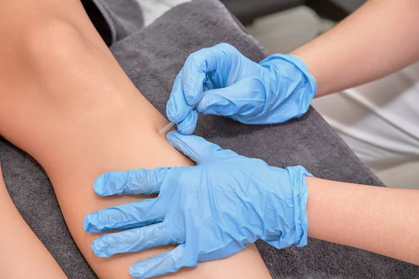 Close-up of shirtless man receiving dry needling therapy from physician in clinic Close-up of physiotherapist performing dry needling treatment on leg. Injury recovery procedure