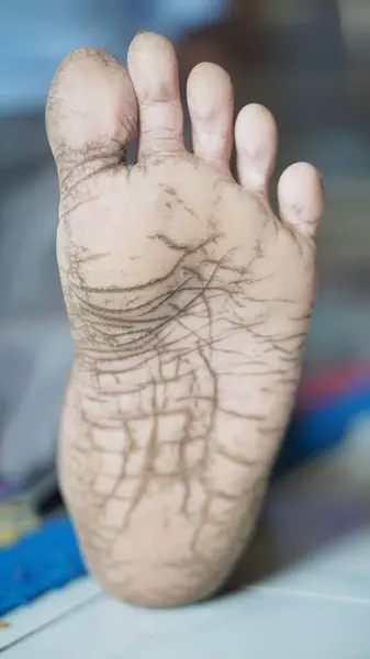 Bir adamda kırık ayak hastalığı