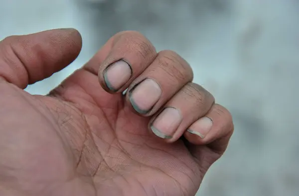 Tırnaklarının altında toprak var. Tırnakların altındaki toprak bir enfeksiyon kaynağıdır. kişisel hijyen eksikliği.