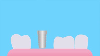 Diş implantı. Minimum modern hareket tasarımı. Soyut canlandırma