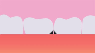 Dişlerdeki bakirelerin görünüşü. Canlandırma 2D