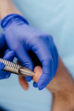 Doktor lazer ışınıyla benleri ve siğilleri temizler. Köstebek temizleme, plastik cerrahi, estetik ilaç, cilt kanseri önleme