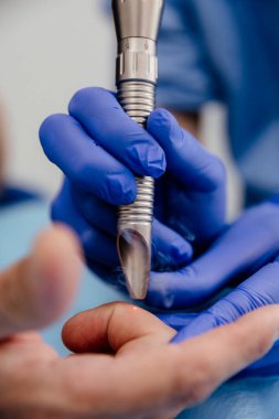 Doktor lazer ışınıyla benleri ve siğilleri temizler. Köstebek temizleme, plastik cerrahi, estetik ilaç, cilt kanseri önleme