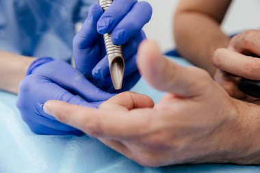 Doktor lazer ışınıyla benleri ve siğilleri temizler. Köstebek temizleme, plastik cerrahi, estetik ilaç, cilt kanseri önleme