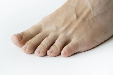 Pedikürsüz kadın bacakları beyaz, dağınık, hastanın ayağı podolojistin sandalyesinde manikürsüz. Pedikür yaptıran hasta, ayak hastalıkları uzmanı. Ayaklar soyuluyor. SPA salonunda ayak tedavisi.