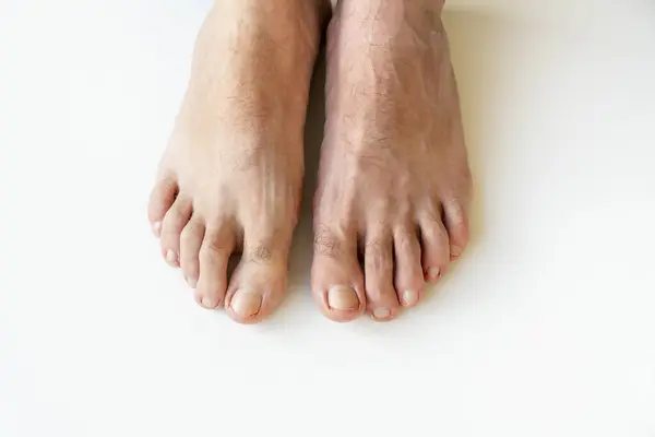 Podolojistin sandalyesinde manikürsüz hastanın ayakları. Pedikür yaptıran hasta, ayak hastalıkları uzmanı. Ayaklar soyuluyor. Düz taban