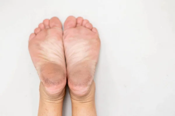Fötter Med Torr Hud För Att Visa Den Ohälsosamma Foten — Stockfoto