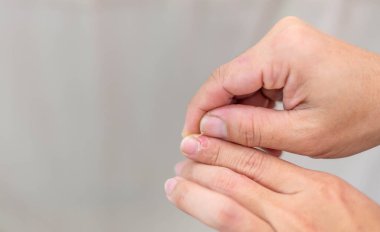 Dişinin eli kurumuş, tırnak derisi çatlamış, derisi yırtılmış ve pul pul dökülmüş. Tamir için nemlendirici ile tedavi edilmeli..