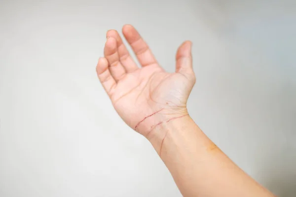 Female hand skin condition after cat scratch and bite of veterinary surgeon hand during physical examination.