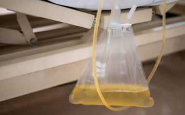 The urine or pee catheter bag hangs under a patient's bed in a hospital.
