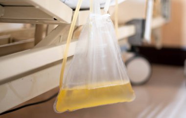 The urine or pee catheter bag hang under patient bed in hospital.