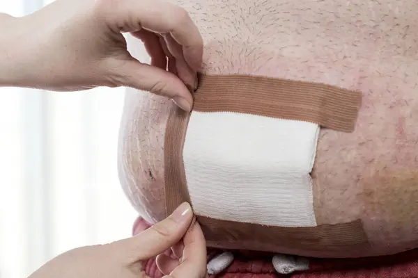 Hastanın Göbek Bağı Yarasını Saran Dezenfeksiyon Yaptıktan Sonra Steril Gazlı — Stok fotoğraf