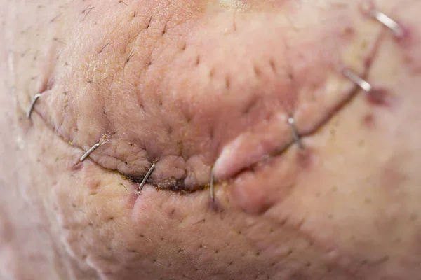 Detail Umbilical Hernia Incision Stitches Surgery Selective Focus Scar — Stock Photo, Image