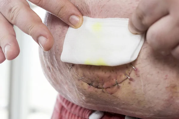 Részlet Beteg Kezéről Amint Gézt Tart Köldökgombján Köldöksérv Sebének Kötése — Stock Fotó