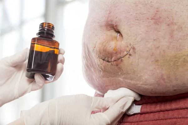 Részlet Nővér Kezét Kezelésére Bőr Körül Betegek Köldöksérv Seb Orvosi — Stock Fotó