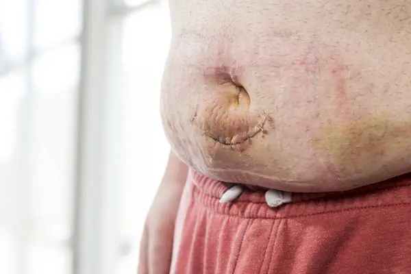 Detail Umbilical Hernia Incision Stitches Surgery Selective Focus Scar Belly — Stock Photo, Image