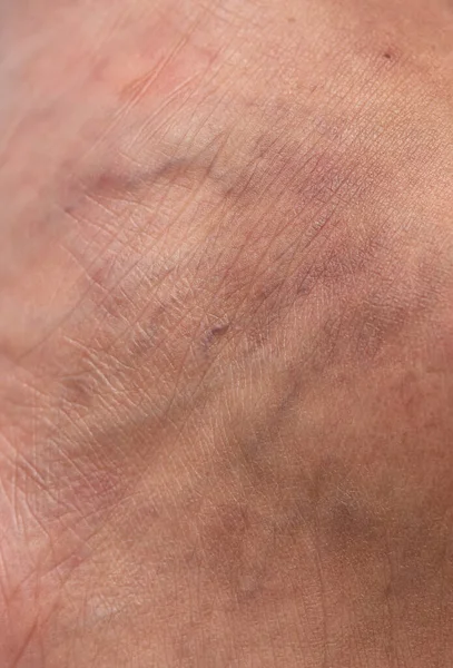 Varicose veins and capillary veins on human skin texture background