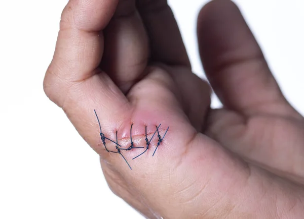 Hand injured by a cut. Surgical suture made by a surgeon on white background. scar, suture, accident