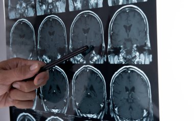 Doctors reviewing brain x-rays;MRI of the blood vessels in the brain and cerebrovascular disease or hemorrhagic stroke.