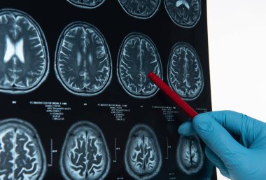 Doctors reviewing brain x-rays;MRI of the blood vessels in the brain and cerebrovascular disease or hemorrhagic stroke.