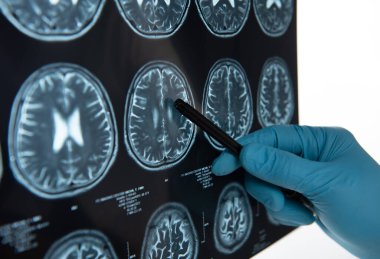 Doctors reviewing brain x-rays;MRI of the blood vessels in the brain and cerebrovascular disease or hemorrhagic stroke.