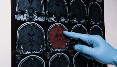 Doctors reviewing brain x-rays;MRI of the blood vessels in the brain and cerebrovascular disease or hemorrhagic stroke.
